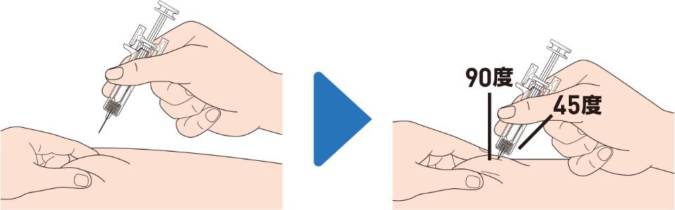 片方の手で消毒した皮膚をつまみ、つまんだ皮膚に対して45度から90度の角度で針を挿入します。